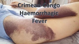 Crimean Congo Haemorrhagic Fever [upl. by Eidlog]