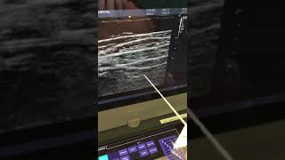 Tap block subcostal approach [upl. by Ynad632]