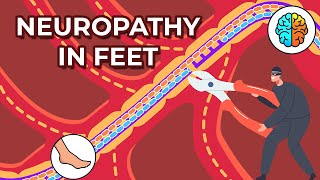 Dealing with Neuropathy in Feet Causes Symptoms and Treatments [upl. by Leirbma90]