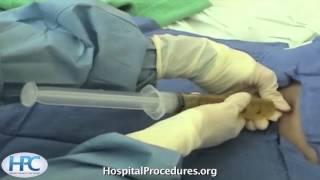 Paracentesis Procedure Video Trailer [upl. by Thain831]