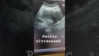 Uterus Ultrasound education ultrasound pelvic pelvis medical sonography study uterusproblem [upl. by Assirim12]