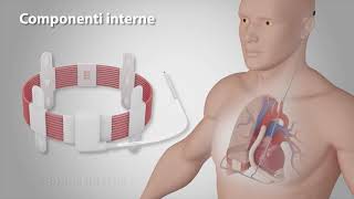 Come funziona il cuore wireless FIVAD di Leviticus Cardio animazione italiano [upl. by Namielus]