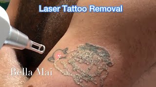 Laser Tattoo Removal  Before After 1st 2nd amp 3rd sessions [upl. by Flann]