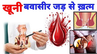 बवासीर का इलाज। बवासीर का घरेलू इलाज। Piles ka Ilaj। Piles Treatment । बवासीर की आयुर्वेदिक दवा [upl. by Og144]