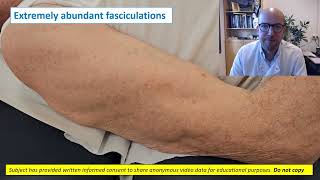 Needle EMG fasciculations [upl. by Stich]