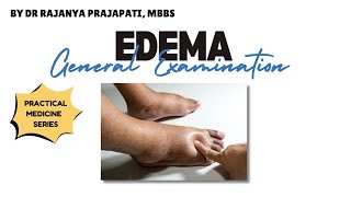 Edema l General Examination l Practical Medicine Series l By Dr Rajanya MBBS [upl. by Farah624]