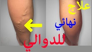 وصفات طبيعية  علاج الدوالي بالاعشاب مجرب 3ilaj dawali [upl. by Comstock595]