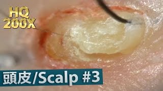 3 Scalp Blackhead Removal Close up HQ200X [upl. by Nemracledairam]