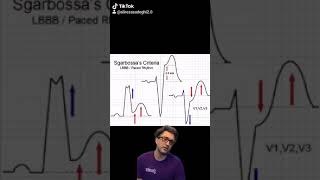 sgarbossa criteria made easy [upl. by Ladiv]