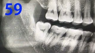 Lower vertical wisdom tooth extraction with elevator hufriedy el 3c [upl. by Anaiek820]