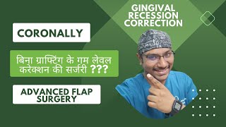 Dr Rudra Mohan  बिना ग्राफ्टिंग के गम लेवल करेक्शन की सर्जरी  Coronally Advanced Flap Surgery [upl. by Kcirrad937]