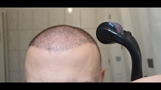 Minoxidil amp Dermarolling Results 6 MONTHS  Month by Month Progress [upl. by Samson]