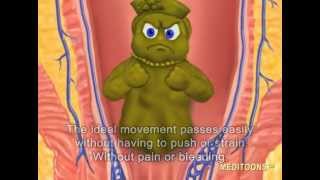 What Causes Hemorrhoids Treatment and Cure Meditoons™ [upl. by Brookner519]