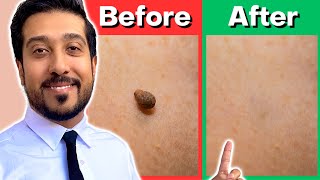 How to Remove Skin Tags Yourself AT HOME  Get Rid of Skin Tags NOW [upl. by Llerrej]