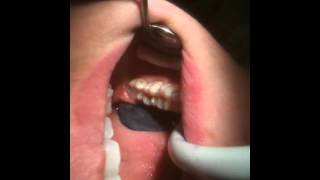 12070601 cap°dent composite occlusal dent de sagesse [upl. by Marley]