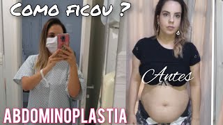 MOSTREI MEU CORPO 3 MESES APÓS ABDOMINOPLASTIA 5 [upl. by Firehs]