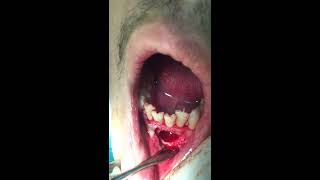 Dental Oral Surgery Apicoectomy Taibah University College of Dentistry [upl. by Suirtemid]