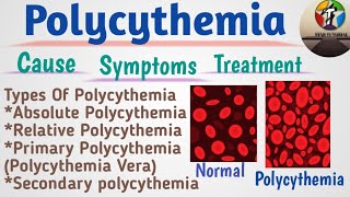 Polycythemia In Hindi ll Polycythemia Vera ll Hematology And Blood Banking [upl. by Hewe613]