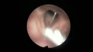 Paper Pin Foreign Body OVER Vocal Cord [upl. by Allsopp]