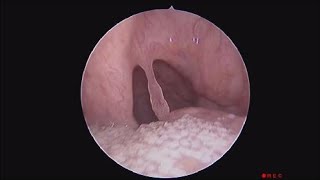 Pedunculated Polyp of The Throat [upl. by Lativa]