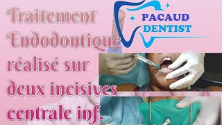 DÉVITALISATION DENTAIRE  Toutes les étapes dun Traitement Endodontique Dent antérieure [upl. by Noxid20]