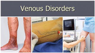 Venous Disorders 3  Saphena Varix Deep Venous Thrombosis [upl. by Leimaj]