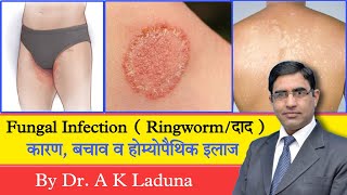 Ringworm Fungal Infection Complete information [upl. by Selrac]