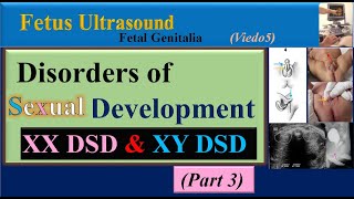 Fetus Ultrasound Disorders of Sexual Development Part3 [upl. by Sarat]