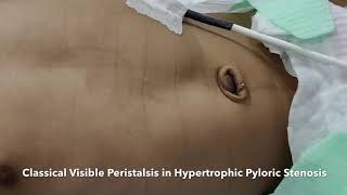 Visible Peristalsis in Pyloric Stenosis Classical Peristaltic Wave of Hypertrophic Pyloric Stenosis [upl. by Htor]