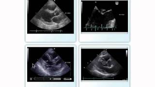 Native Valve Endocarditis [upl. by Mccord]