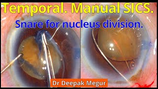 Manual SICS and minimal Surgical Induced Astigmatism  Dr Deepak Megur [upl. by Eremehc]