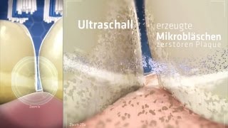 So funktioniert die Zahnreinigung mit echtem Ultraschall  emmident [upl. by Dlanod]