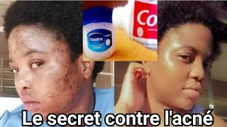 Comment traiter les boutons sur le visage  Un remède fait maison contre lacnéColgate et Vaseline [upl. by Ardaid499]