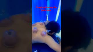 Cupping tharepy for back pain [upl. by Aihtibat]