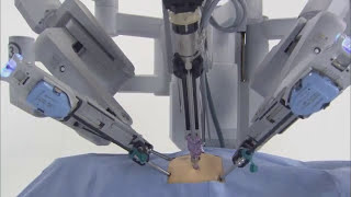 da Vinci® Robotic Surgical System [upl. by Galatea673]