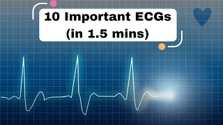 10 Important ECGs in 15 mins cardiology ecg ekg [upl. by Myron]