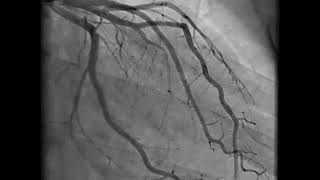 Coronary Angiography  NEJM [upl. by Ervine]