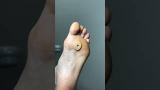 Watch These Corns Get Removed in Seconds satisfying podiatry foot [upl. by Nanor516]