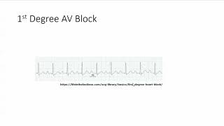 First degree AV block [upl. by Kynan]