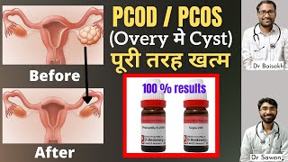 Best homeopathic medicine for PCODPCOS overy me cyst ka homeopathic ilaj [upl. by Terrilyn]