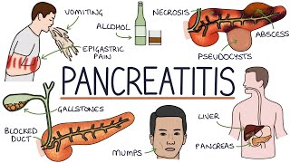 Understanding Pancreatitis [upl. by Nesnej661]