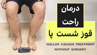 درمان هالوکس والگوس یا قوز شست پا How to fix your Hallux valugus Easy way to treat your Bunion [upl. by Corbett491]