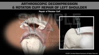 Arthroscopic Decompression amp Rotator Cuff Repair of Left Shoulder [upl. by Jacobina]