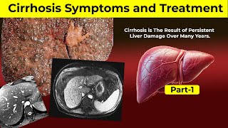 Liver Cirrhosis Symptoms and Treatment  Part1  Hepatitis  Liver Problem Symptoms  HealthWisdom [upl. by Iana]