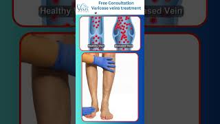 Varicose Vein Removal Phlebectomy Procedure By Best Vascular Surgeon telugu VaricoseVeins shorts [upl. by Raviv375]