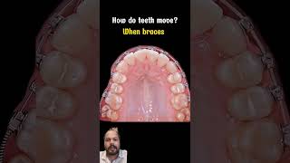 Orthodontics braces shortsfeed duet dentistteeth viralvideo dentistdoctor dentist trending [upl. by Sissie239]