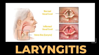 Laryngitis  Urdu  Hindi [upl. by Asatan]