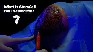 What is stem cell hair transplantation [upl. by Zabrina]