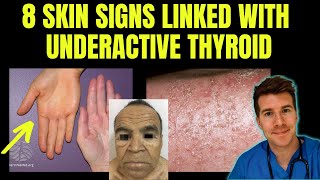 Spot Hypothyroidism No Labs Needed [upl. by Krischer]