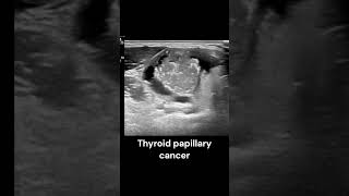 Thyroid Papillary Cancer ultrasound imaging radiology cancer endocrinology cases [upl. by Drusi699]